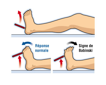 babinski